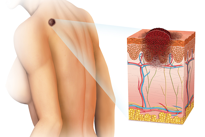cancer de piele paraziților intestinali tratament